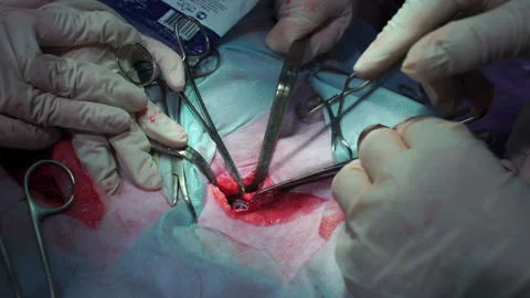 Surgery. The doctor's hands measure the cut with a ruler Video stock 91610467