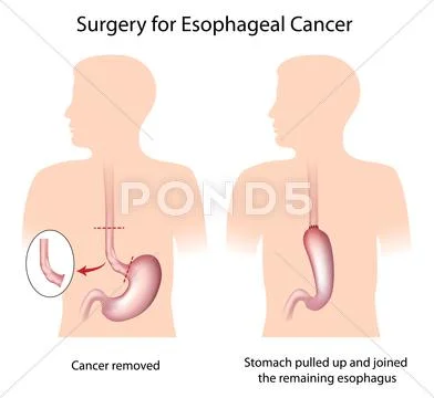 Surgery for esophageal cancer Stock Illustration