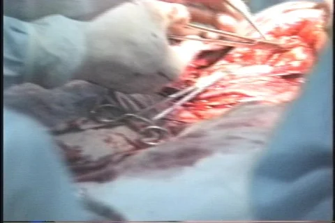 Surgery Stock Footage 300576
