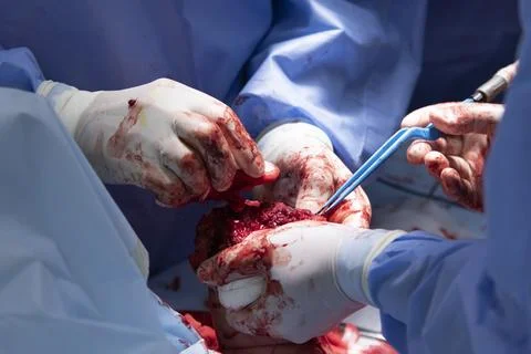 Surgery of Hand Amputation Closeup 写真素材