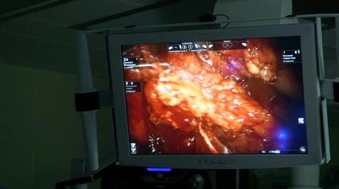 Surgery on the heart. Video stock 68143716