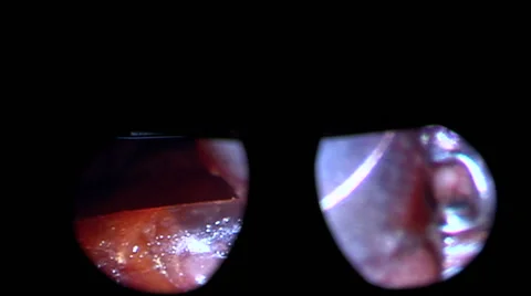 Surgery on the heart. Stock-Footage 68143839