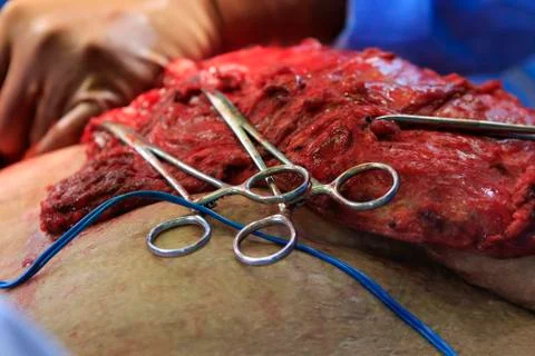 Surgery with hemostats Фото