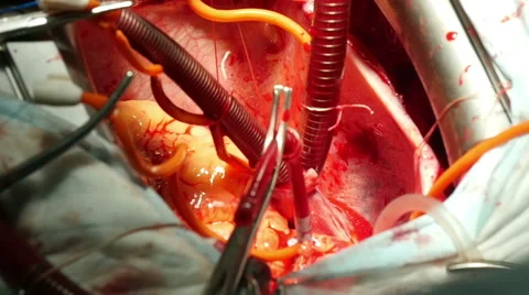 Surgery on the human heart, close-up Stock-Footage 61036624