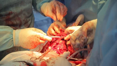 Surgery with implanting titanium jaw. Hands of surgeon operating patient`s jaw. Video stock 99200769