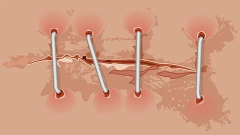 Surgery incision Stock Illustration
