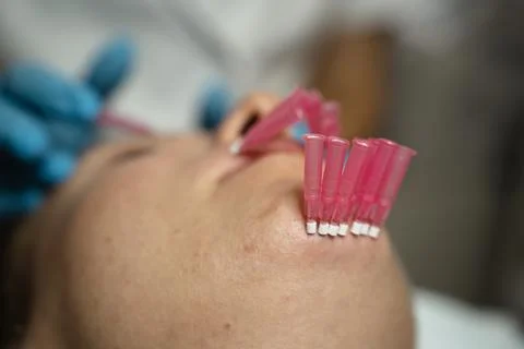 Surgery to insert PDO threads under the skin, facelift. Innovative procedure. Stock Photos