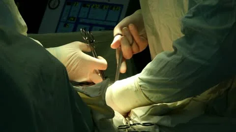 Surgery on the intestines 13 Stock-Footage 12429757