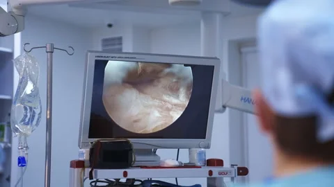 Surgery with laparoscopic equipment Video stock 149289615