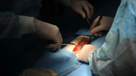 Surgery on the leg Stock Footage 59320258
