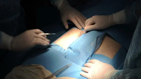 Surgery on the leg Stock Footage 62747492