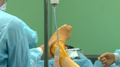 Surgery on the leg. Video stock 68143532