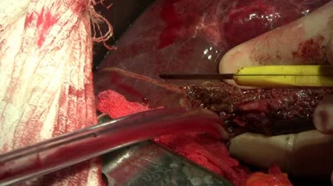 Surgery on the liver Stock Footage 10835106