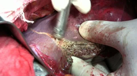 Surgery on the liver Stock Footage 10835108