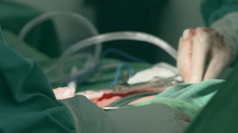 Surgery moment Stock Footage 118921345