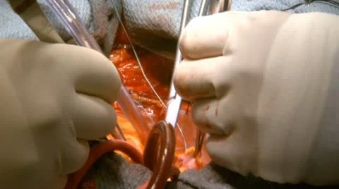 Surgery Open Heart Close-Up Suturing Vídeos de archivo 20959011