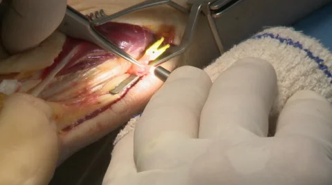 Surgery in an operating room Video stock 53812678