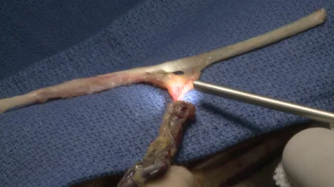 Surgery in an operating room Stock Footage 53813521