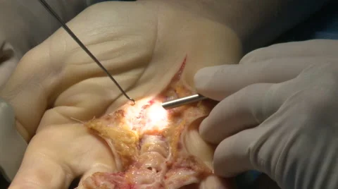 Surgery in an operating room Stock Footage 53817413