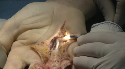 Surgery in an operating room Stock Footage 53818006