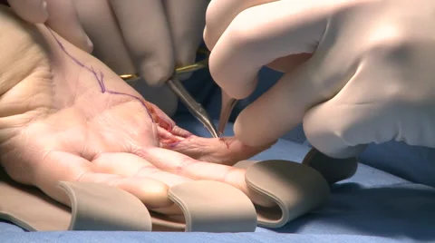 Surgery in an operating room Stock Footage 53818422