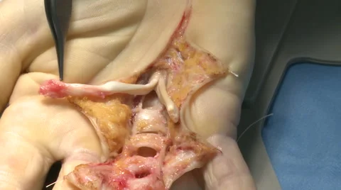 Surgery in an operating room Video stock 53821158