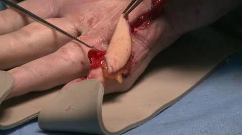 Surgery in an operating room Stock Footage 53821395