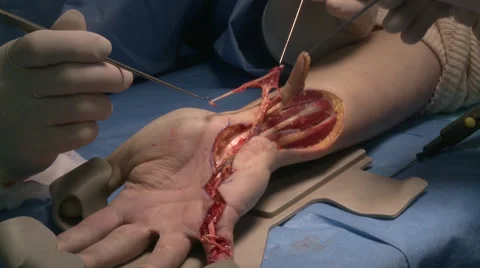 Surgery in an operating room Video stock 53821651