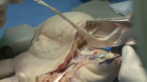 Surgery in an operating room Stock Footage 53822691