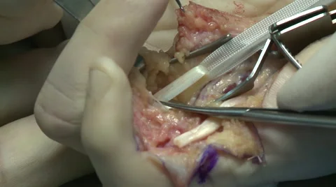 Surgery in an operating room Video stock 53824112