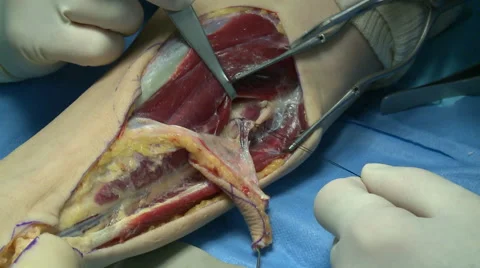 Surgery in an operating room 스톡 동영상 53824416