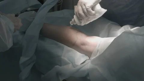 Surgery in the operating room Video stock 143160244