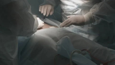 Surgery in the operating room Video stock 143160268
