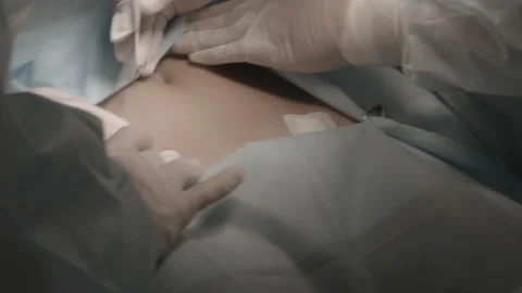 Surgery in the operating room Video stock 143160315