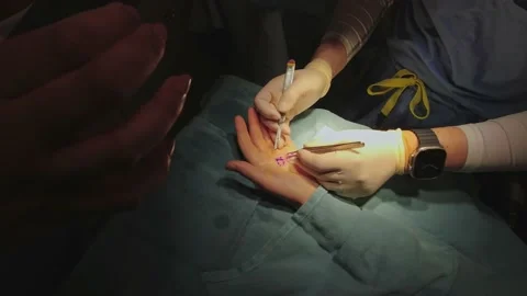 Surgery operation on human hand palm, operation in surgery room. Surgical t.. Video stock 239177474