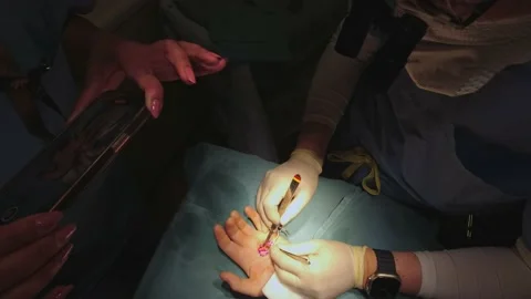 Surgery operation on human hand palm, operation in surgery room. Surgical t.. Stock Footage 239177489