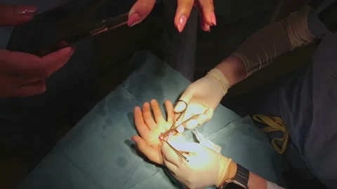 Surgery operation on human hand palm, operation in surgery room. Surgical t.. Stock-Footage 239177497