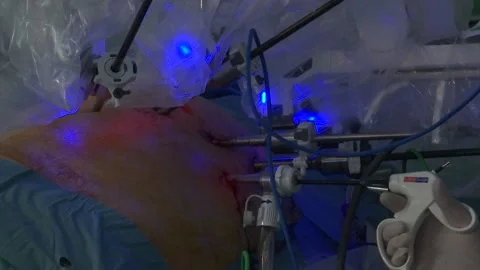 A SURGERY OPERATION WITH A MACHINE Stock Footage 201741599