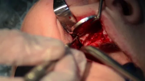 Surgery in the oral cavity Video stock 59681986