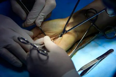 Surgery in the palm Stockfoto's