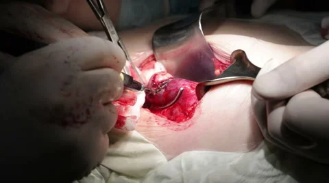 Surgery to remove the cancer Stock Footage 62746938