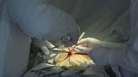Surgery to remove a hernia. Close-up Stock Footage 58578549