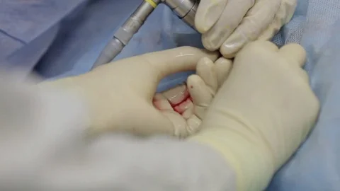 Surgery for remove kidney stones. Video stock 80967769