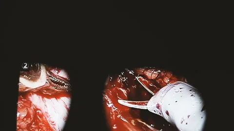 Surgery. Robotic operation. Stock Footage 99878125