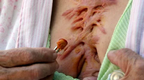 Surgery scar Video stock 10804816