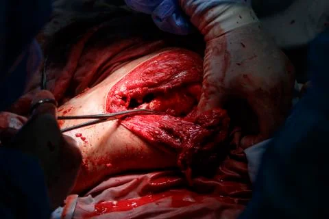 Surgery with shoulder bone Stockfoto's