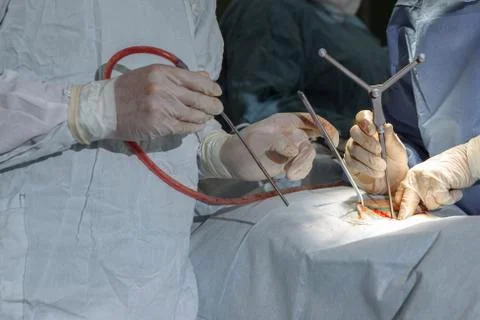 Surgery on the spine. The hands of doctors in gloves hold a surgical instrument. Stock Photos