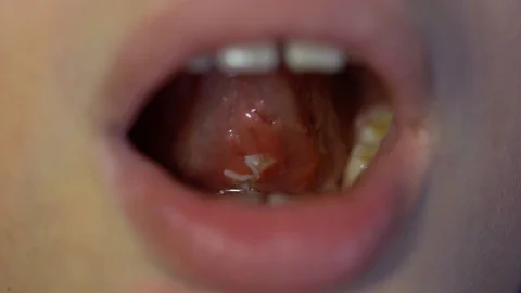 surgery stitches under tongue after oper... | Stock Video | Pond5