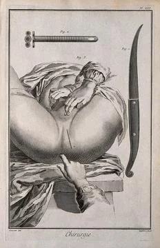 Surgery: surgical instruments including a small tube for inserting into the.. Stock Illustration