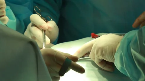 Surgery team operating Stock Footage 86597890
